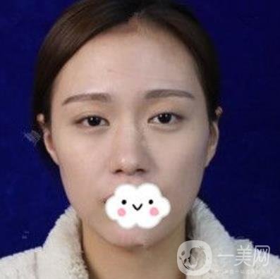 臺州博雅美惠醫(yī)療美容整形雙眼皮恢復日記，內(nèi)附價格表明細