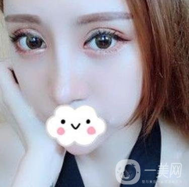 臺州博雅美惠醫(yī)療美容整形雙眼皮恢復日記，內(nèi)附價格表明細