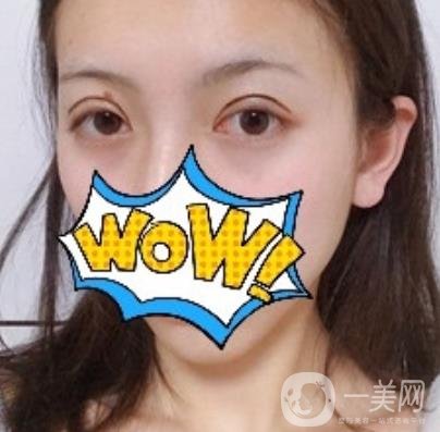 武漢艾萊美醫(yī)療整形醫(yī)院價格表項目收費明細，附雙眼皮案例