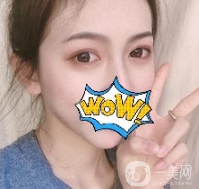 武漢艾萊美醫(yī)療整形醫(yī)院價格表項目收費明細，附雙眼皮案例