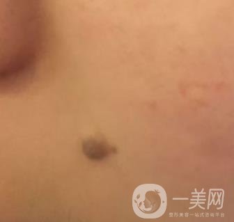 重醫(yī)附一院祛痣怎么樣?多少錢一顆?附整形價(jià)格表及案例*果