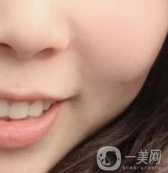 重醫(yī)附一院祛痣怎么樣?多少錢一顆?附整形價(jià)格表及案例*果