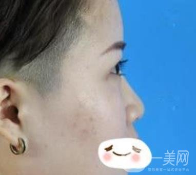 四川省人民醫(yī)院整形科駝峰鼻矯正多少錢？價(jià)格表2020更新