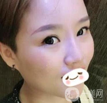 四川省人民醫(yī)院整形科駝峰鼻矯正多少錢？價(jià)格表2020更新