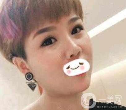 四川省人民醫(yī)院整形科駝峰鼻矯正多少錢？價(jià)格表2020更新