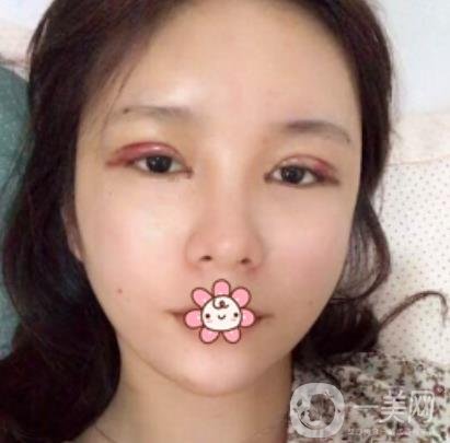 襄陽(yáng)中心醫(yī)院整形美容科價(jià)格表2020版出爐，附雙眼皮日記