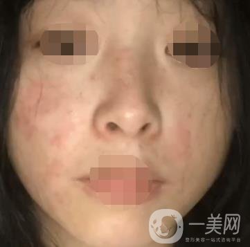 岳陽市一人民醫(yī)院整形美容科價(jià)格表及祛斑案例發(fā)布