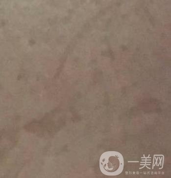 廣州名韓整形醫(yī)院價格表費用詳情+激光祛斑案例分享