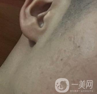 廣州名韓整形醫(yī)院價格表費用詳情+激光祛斑案例分享