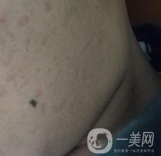 廣州名韓整形醫(yī)院價格表費用詳情+激光祛斑案例分享