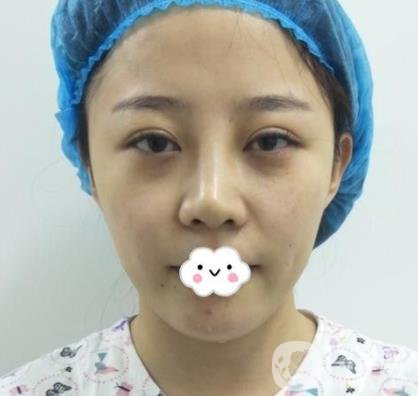 合肥中山醫(yī)院整形科價(jià)格表2020，附雙眼皮恢復(fù)*果