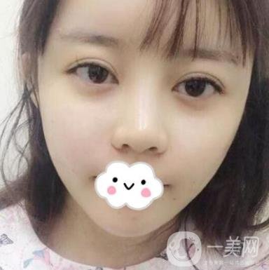 合肥中山醫(yī)院整形科價(jià)格表2020，附雙眼皮恢復(fù)*果