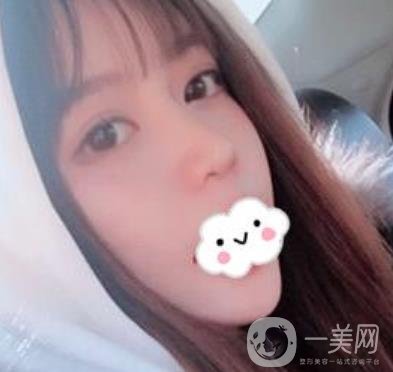 合肥中山醫(yī)院整形科價(jià)格表2020，附雙眼皮恢復(fù)*果