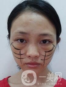 徐州亞韓整形醫(yī)院價(jià)格表費(fèi)用明細(xì)，附面部除皺日記展示