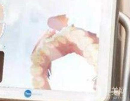 武漢大學(xué)口腔醫(yī)院牙齒矯正多少錢?*果好嗎?價格費(fèi)用明細(xì)一覽