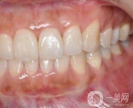 武漢大學(xué)口腔醫(yī)院牙齒矯正多少錢?*果好嗎?價格費(fèi)用明細(xì)一覽