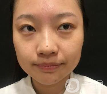 北京知音醫(yī)療美容熱瑪吉*果怎么樣？貴嗎？收費價格表2020公布