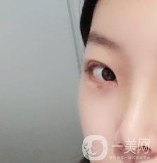 無(wú)錫二院雙眼皮做得好的醫(yī)生?附2020整形價(jià)格表及案例