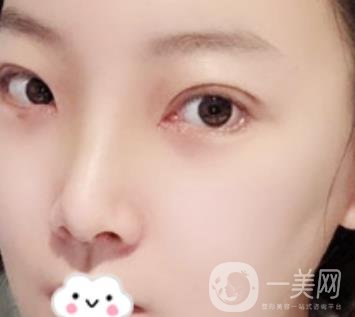 無(wú)錫二院雙眼皮做得好的醫(yī)生?附2020整形價(jià)格表及案例