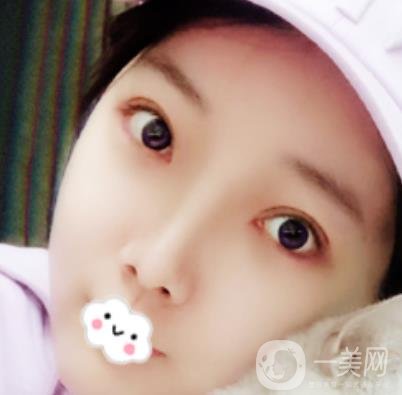 無(wú)錫二院雙眼皮做得好的醫(yī)生?附2020整形價(jià)格表及案例