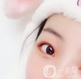 無(wú)錫二院雙眼皮做得好的醫(yī)生?附2020整形價(jià)格表及案例