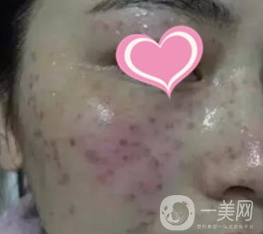 徐州二院激光祛斑怎么樣?案例及2020整形價(jià)格表一覽