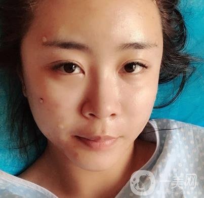 重醫(yī)附一院祛痣多少錢一顆?2020整形價格表及案例*果圖分享