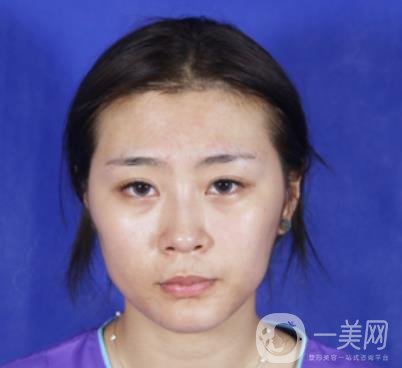 重醫(yī)附一院祛痣多少錢一顆?2020整形價格表及案例*果圖分享