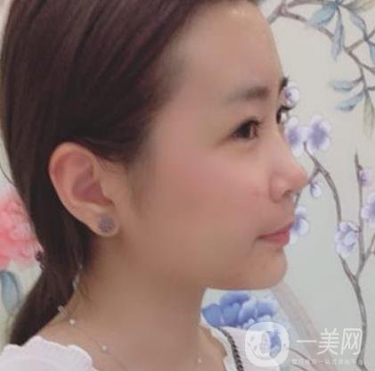 重醫(yī)附一院祛痣多少錢一顆?2020整形價格表及案例*果圖分享