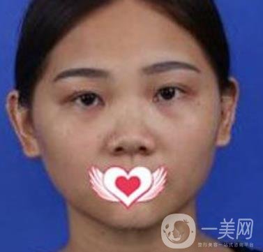 交大一附院王瑞做鼻子怎么樣？?jī)r(jià)格表及術(shù)后*果分享