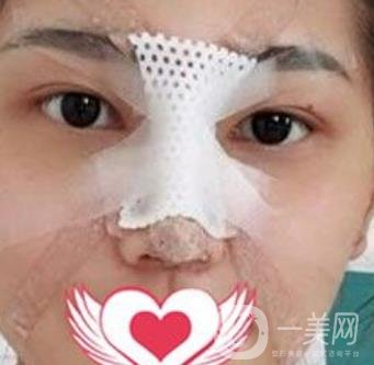 交大一附院王瑞做鼻子怎么樣？?jī)r(jià)格表及術(shù)后*果分享