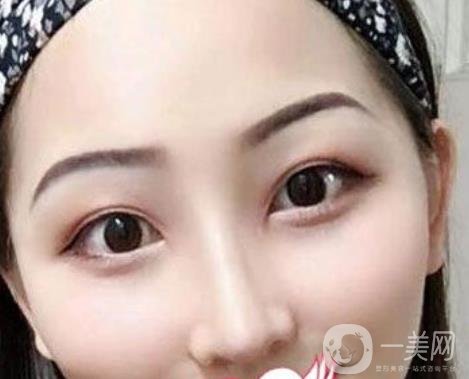 交大一附院王瑞做鼻子怎么樣？?jī)r(jià)格表及術(shù)后*果分享