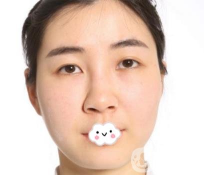 南昌二附院整形科新版價格表發(fā)布,附隆鼻案例前后