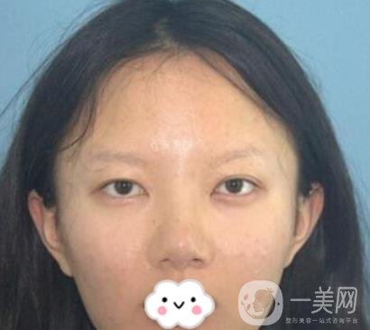 贛南醫(yī)學(xué)院第一附屬醫(yī)院整形美容科價(jià)格表2020+雙眼皮案例一覽