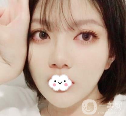 贛南醫(yī)學(xué)院第一附屬醫(yī)院整形美容科價(jià)格表2020+雙眼皮案例一覽