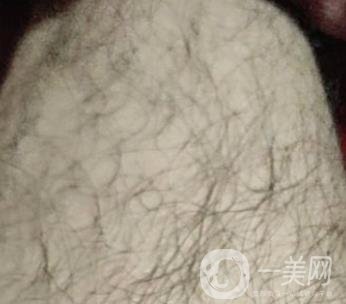 合肥華美整形醫(yī)院價(jià)格表，附脫毛案例