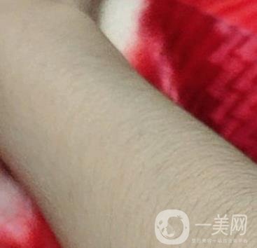 合肥華美整形醫(yī)院價(jià)格表，附脫毛案例