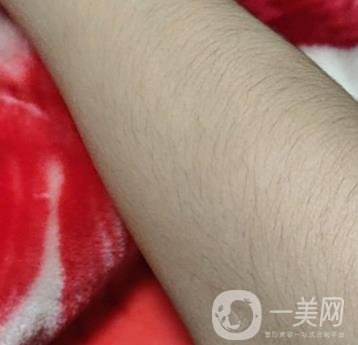 合肥華美整形醫(yī)院價(jià)格表，附脫毛案例