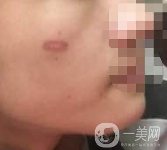 徐州第一人民醫(yī)院整形科價格表，含激光祛疤*果