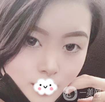 徐州亞韓整形醫(yī)院價格表2020新版+雙眼皮整形日記一覽