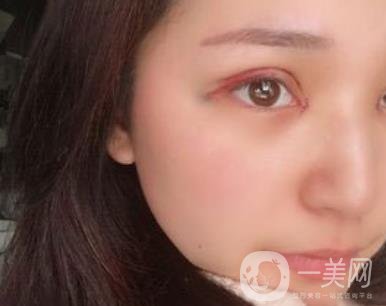 恩施州中心醫(yī)院美容整形科怎么樣？價格表和雙眼皮整形經(jīng)歷分享