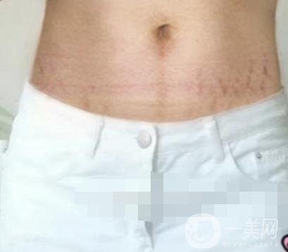 汾陽醫(yī)院美容整形科祛妊娠紋怎么樣？手術(shù)項(xiàng)目收費(fèi)價格表和案例一覽