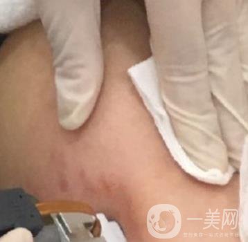 汾陽醫(yī)院美容整形科祛妊娠紋怎么樣？手術(shù)項(xiàng)目收費(fèi)價格表和案例一覽