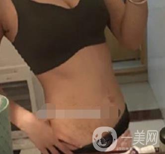 汾陽醫(yī)院美容整形科祛妊娠紋怎么樣？手術(shù)項(xiàng)目收費(fèi)價格表和案例一覽