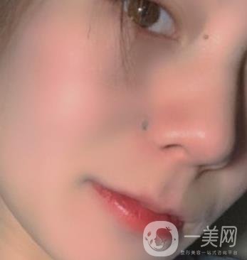 黃岡市中心醫(yī)院美容整形科祛痣多少錢？價格費用表和*果圖精選