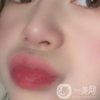 黃岡市中心醫(yī)院美容整形科祛痣多少錢？價格費用表和*果圖精選