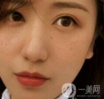 荊州市第三人民醫(yī)院整形美容科*祛斑*果好嗎？收費價格明細表一覽