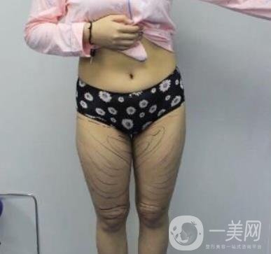 武漢市武昌醫(yī)院整形美容科價(jià)格表和吸脂瘦大腿案例精選圖公布