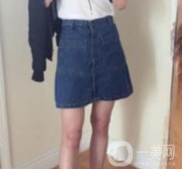 武漢市武昌醫(yī)院整形美容科價(jià)格表和吸脂瘦大腿案例精選圖公布