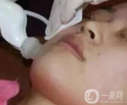 湖南省人民醫(yī)院點(diǎn)陣激光祛斑價(jià)格表及案例分享